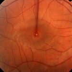 Full-Thickness Macular Hole