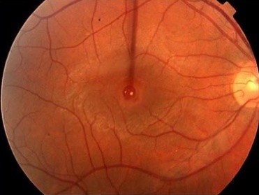 Full-Thickness Macular Hole: Staging, OCT Findings, and Surgical Timing
