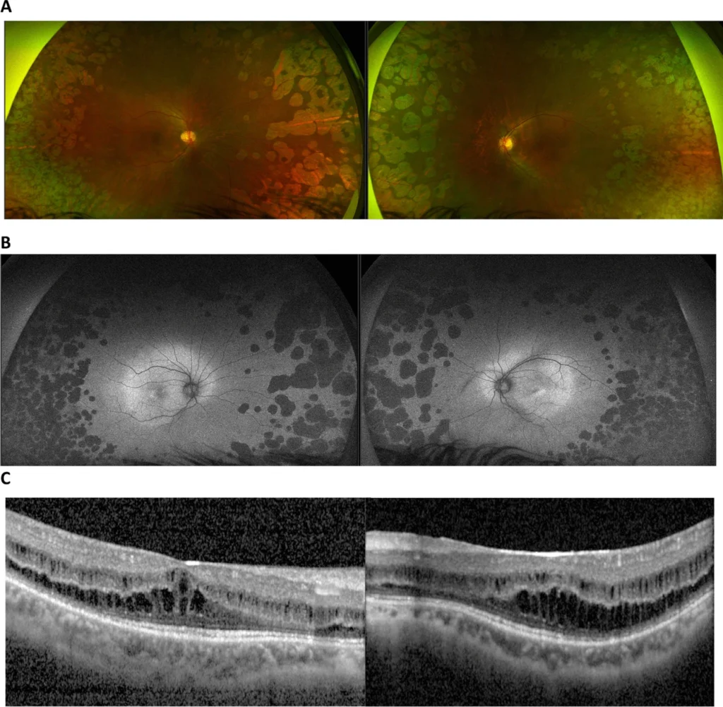 Fundus autofluorescence imaging shown alongside colour fundus photography and OCT, with the autofluorescence panel demonstrating patchy hypo-autofluorescent lesions corresponding to retinal pigment epithelium atrophy