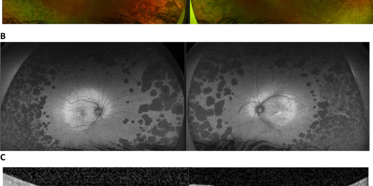 Fundus Autofluorescence: What Lipofuscin Reveals About RPE Health