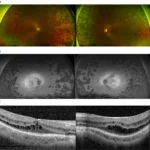 Fundus autofluorescence imaging shown alongside colour fundus photography and OCT, with the autofluorescence panel demonstrating patchy hypo-autofluorescent lesions corresponding to retinal pigment epithelium atrophy