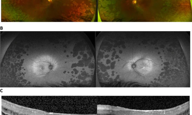 Fundus Autofluorescence: What Lipofuscin Reveals About RPE Health