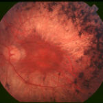 Retinitis pigmentosa: mid-stage fundus showing bone-spicule pigment deposits in the mid-periphery, attenuated retinal arterioles and a waxy pale optic disc