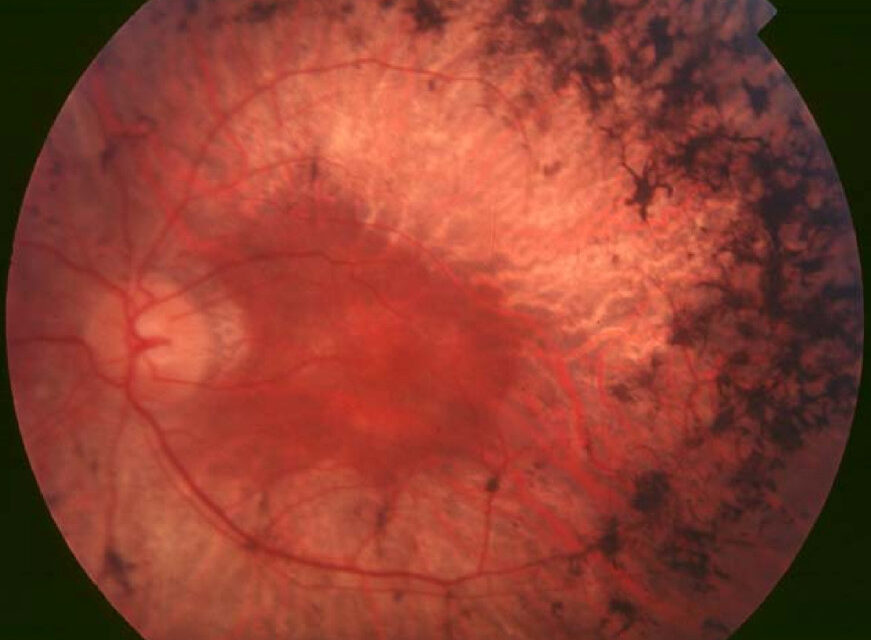 Gene Therapy for Inherited Retinal Disease: A Single Injection, A Single Gene