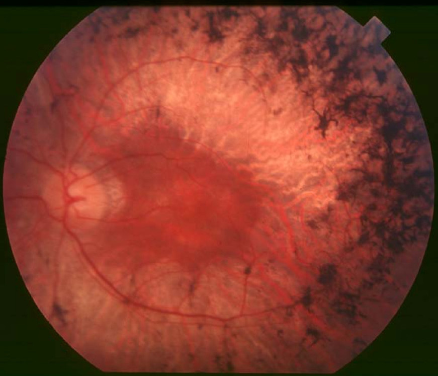 Retinitis pigmentosa: mid-stage fundus showing bone-spicule pigment deposits in the mid-periphery, attenuated retinal arterioles and a waxy pale optic disc