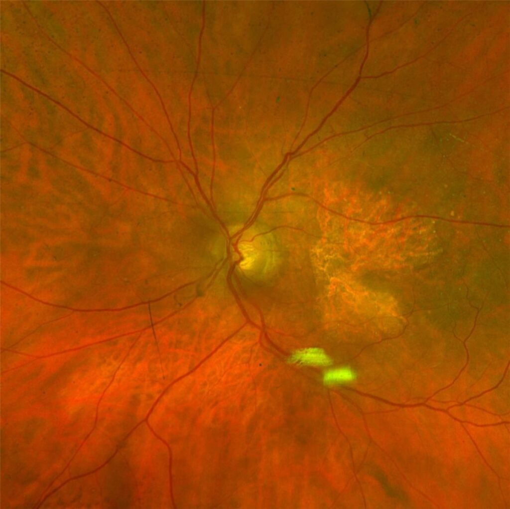 Geographic atrophy: a sharply demarcated area of retinal pigment epithelium and outer retinal atrophy in the macula, with underlying choroidal vessels visible through the atrophic patch