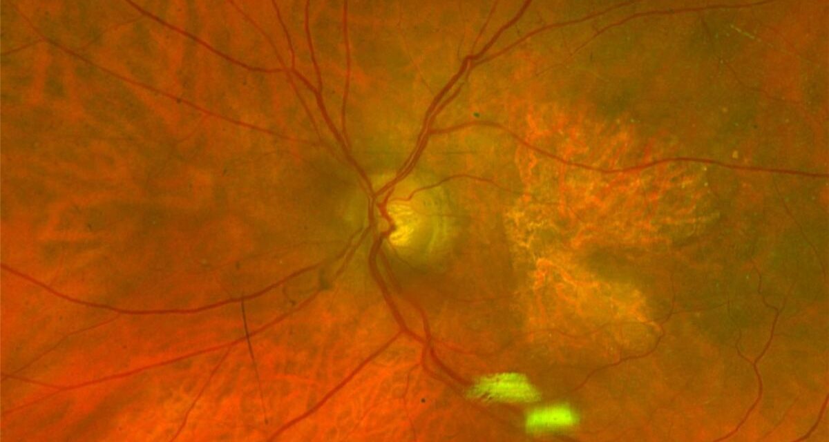 Geographic Atrophy Treatment: Slowing Growth, Not Restoring Vision
