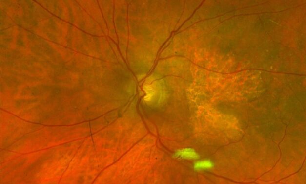 Geographic Atrophy Treatment: Slowing Growth, Not Restoring Vision