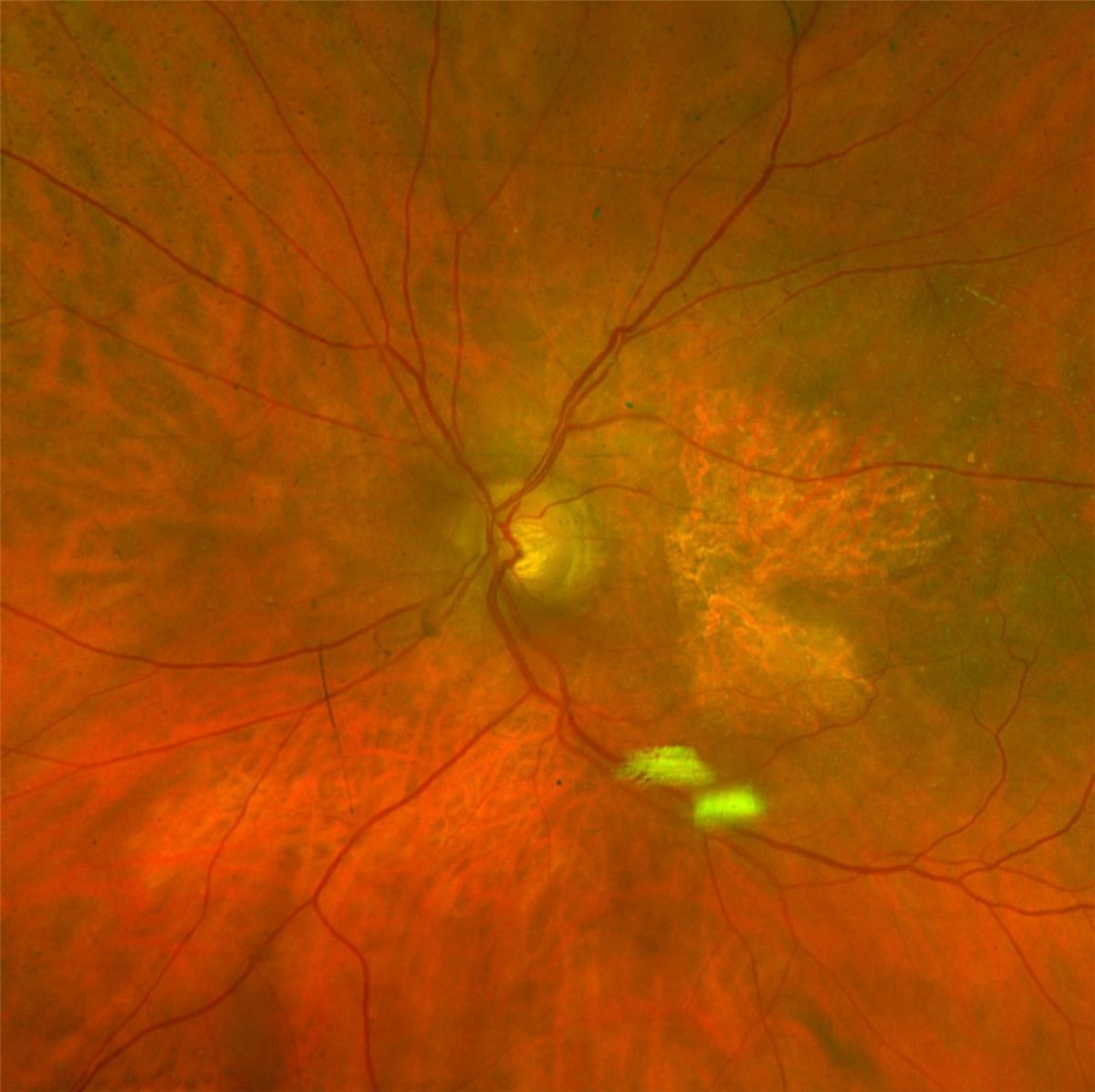 Geographic Atrophy - well-demarcated macular atrophy Geographic atrophy: a sharply demarcated area of retinal pigment epithelium and outer retinal atrophy in the macula, with underlying choroidal vessels visible through the atrophic patch