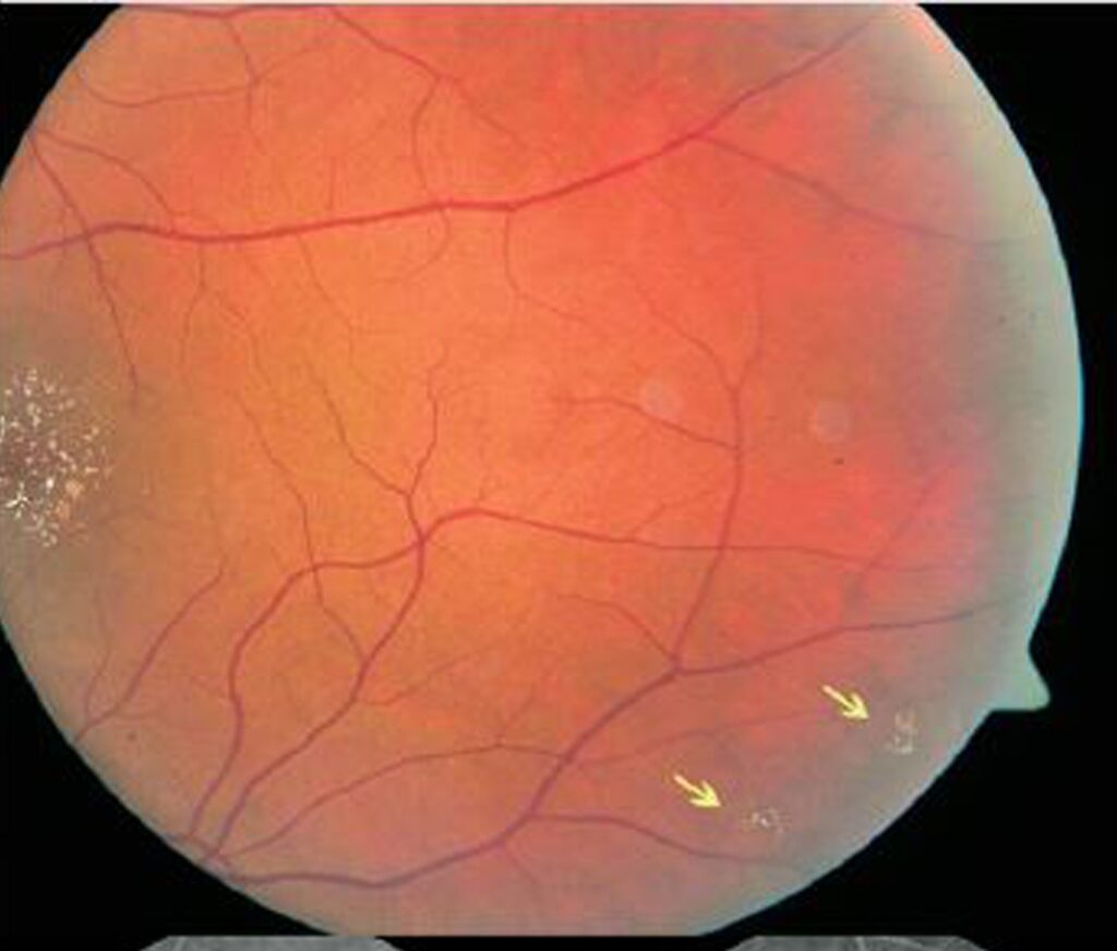  Tamoxifen Retinopathy