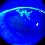 Herpes simplex keratitis: branching, tree-like dendritic corneal ulcer with terminal bulbs highlighted in bright green under fluorescein staining and cobalt blue light
