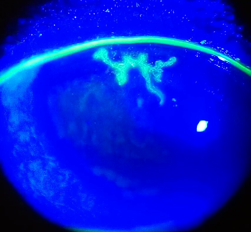 Herpes simplex keratitis: branching, tree-like dendritic corneal ulcer with terminal bulbs highlighted in bright green under fluorescein staining and cobalt blue light