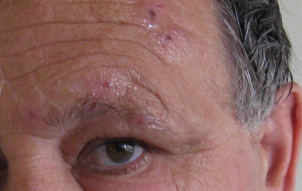 Herpes Zoster Ophthalmicus: The Rash That Predicts Eye Disease