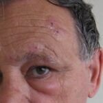 Herpes zoster ophthalmicus: crusted papular skin lesions confined to the forehead and upper eyelid along the ophthalmic (V1) trigeminal dermatome, with periorbital eyelid edema and sparing of the opposite side