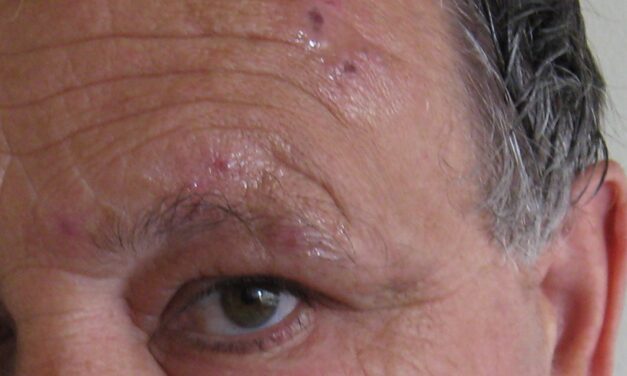 Herpes Zoster Ophthalmicus: The Rash That Predicts Eye Disease