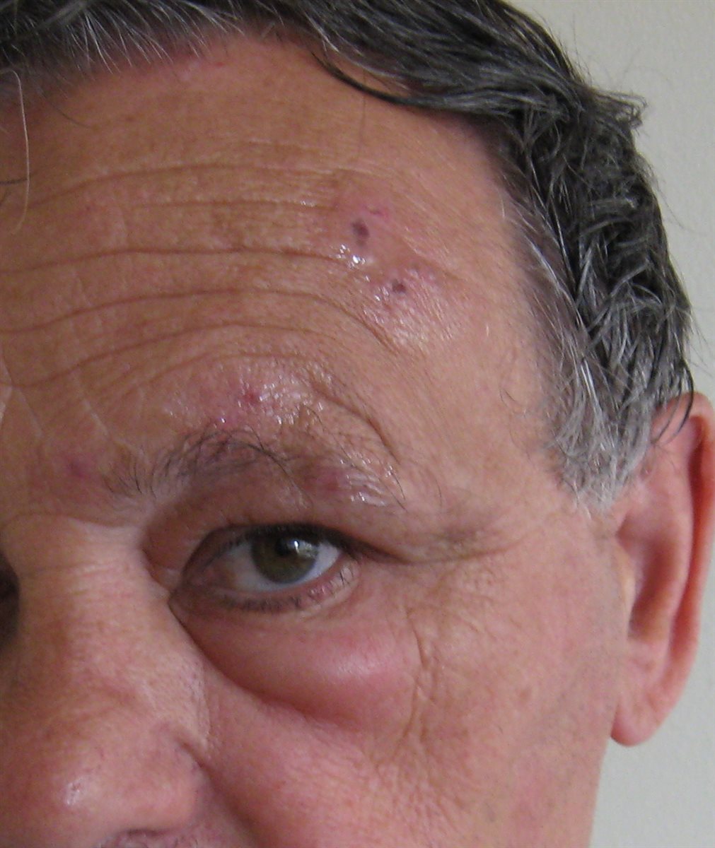Herpes zoster ophthalmicus: crusted papular skin lesions confined to the forehead and upper eyelid along the ophthalmic (V1) trigeminal dermatome, with periorbital eyelid edema and sparing of the opposite side