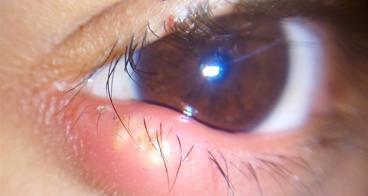 Hordeolum (Stye): The Acute, Painful Eyelid Bump