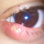 Hordeolum (stye): acute, tender, erythematous swelling at the eyelid margin with a visible yellow-white pointing abscess among the lashes