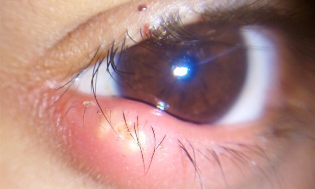 Hordeolum (Stye): The Acute, Painful Eyelid Bump