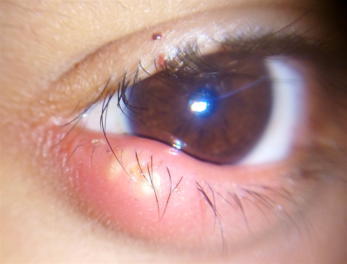 Hordeolum (stye): acute, tender, erythematous swelling at the eyelid margin with a visible yellow-white pointing abscess among the lashes