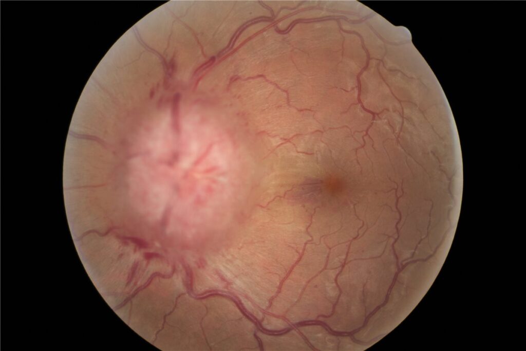 Idiopathic intracranial hypertension: fundus photograph showing a markedly swollen, elevated optic disc with blurred margins, obscured vessels crossing the disc edge and peripapillary hemorrhages