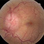 Idiopathic intracranial hypertension: fundus photograph showing a markedly swollen, elevated optic disc with blurred margins, obscured vessels crossing the disc edge and peripapillary hemorrhages