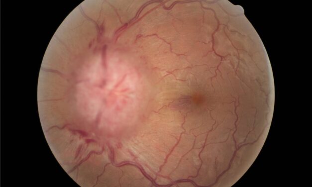 Idiopathic Intracranial Hypertension: The Headache That Quietly Takes the Visual Field