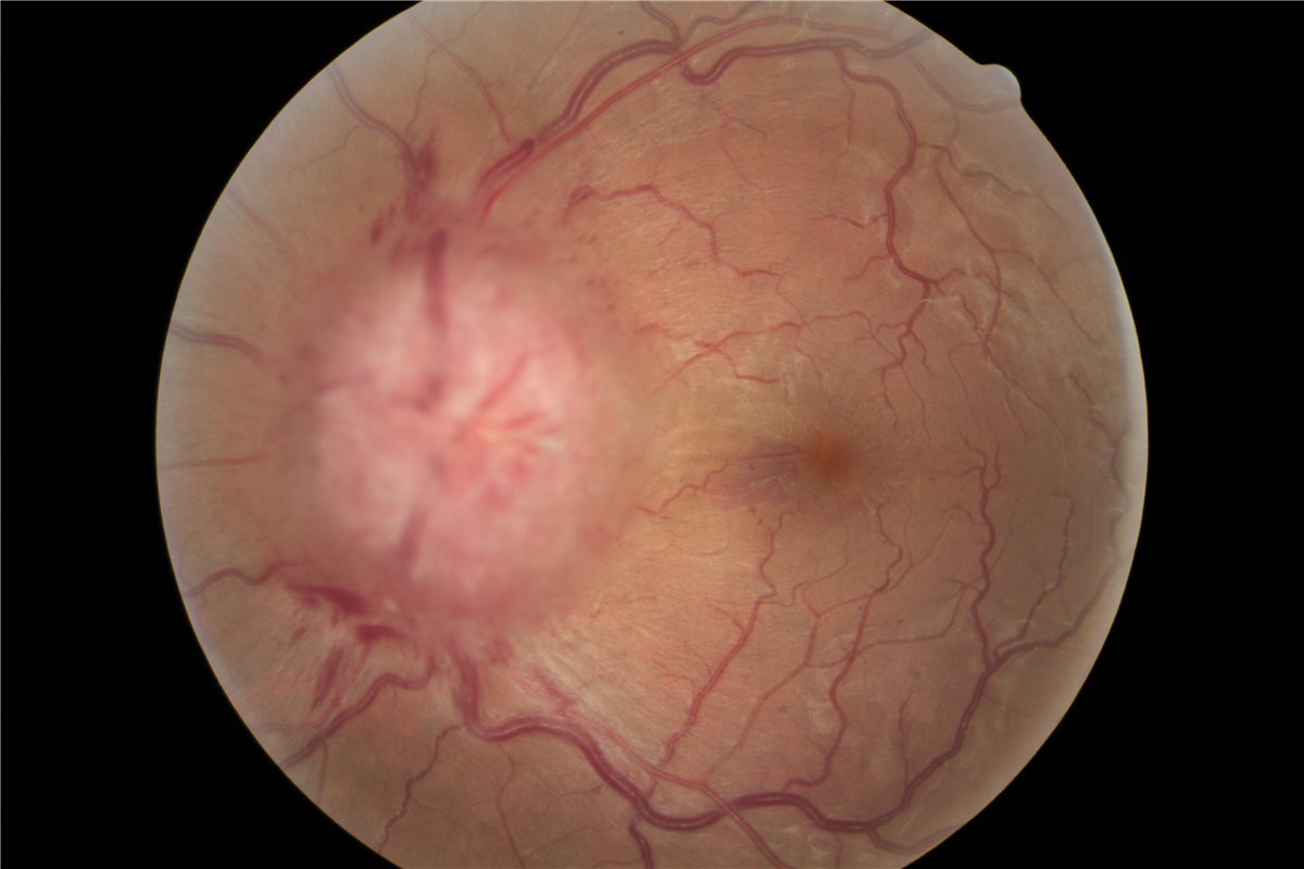 Idiopathic intracranial hypertension: fundus photograph showing a markedly swollen, elevated optic disc with blurred margins, obscured vessels crossing the disc edge and peripapillary hemorrhages
