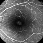 Bull's-Eye Maculopathy