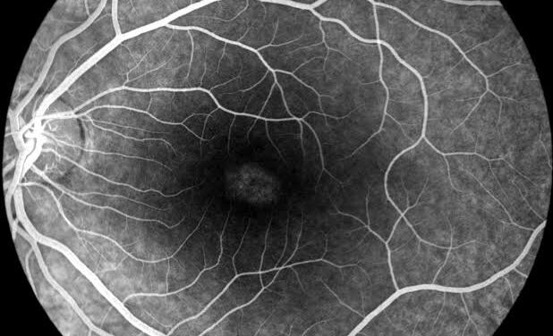 Bull’s-Eye Maculopathy: Not Every Case Is Hydroxychloroquine