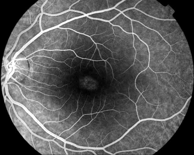 Bull’s-Eye Maculopathy: Not Every Case Is Hydroxychloroquine