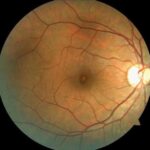 Tamoxifen Retinopathy