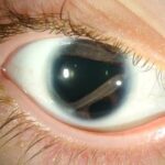 Axenfeld-Rieger syndrome: slit-lamp photographs showing slit pupil and iris atrophy, corectopia, posterior embryotoxon, and peripheral anterior synechiae across affected eyes, alongside dental anomalies