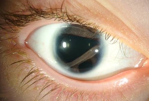 Axenfeld-Rieger Syndrome: Why Lifelong Glaucoma Surveillance Is the Point