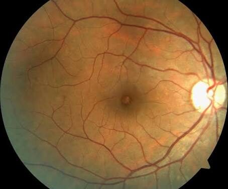 Tamoxifen Retinopathy: A Crystalline Maculopathy You Might Miss