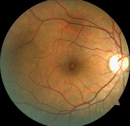 Tamoxifen Retinopathy: A Crystalline Maculopathy You Might Miss