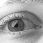 Infantile nystagmus syndrome: the left eye of a male patient showing rapid, involuntary horizontal oscillation typical of congenital nystagmus