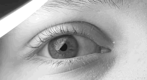 Infantile Nystagmus Syndrome: Separating Idiopathic From Sensory