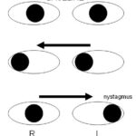Internuclear ophthalmoplegia diagram: schematic of eye positions showing impaired adduction of the right eye on attempted left gaze, with nystagmus of the abducting left eye