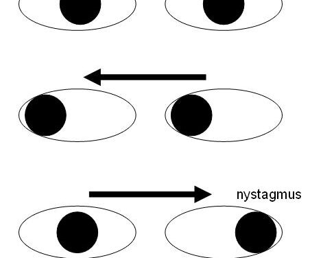 Internuclear Ophthalmoplegia: A Small Finding With a Precise Localisation