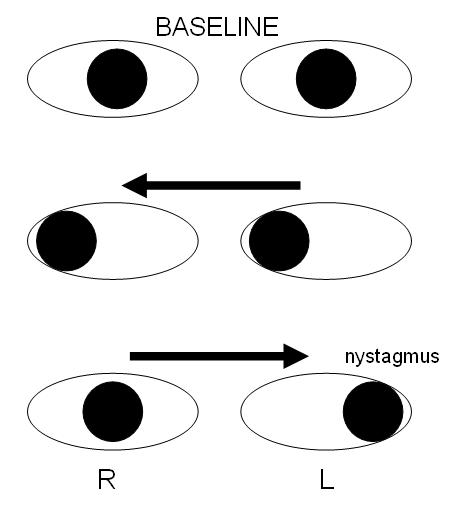 Internuclear Ophthalmoplegia: A Small Finding With a Precise Localisation