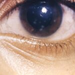 Interstitial keratitis: a close-up of the eye showing diffuse corneal haze and stromal vascularisation from congenital syphilis