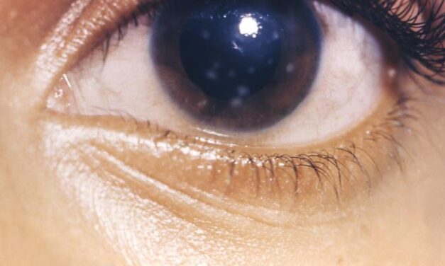 Interstitial Keratitis: A Corneal Diagnosis That Points to Infancy