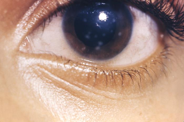 Interstitial Keratitis: A Corneal Diagnosis That Points to Infancy