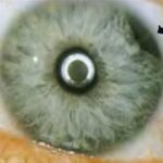 Iridodialysis: a peripheral iris defect at the iris root from blunt ocular trauma, seen as a small dark gap between the iris periphery and the limbus