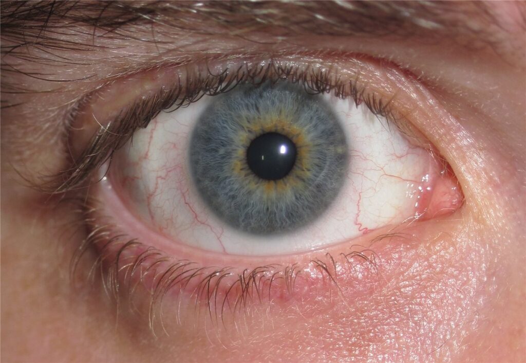 Iris heterochromia: a close-up of a human eye showing central heterochromia, with a golden-brown ring around the pupil contrasting with the blue-grey outer iris