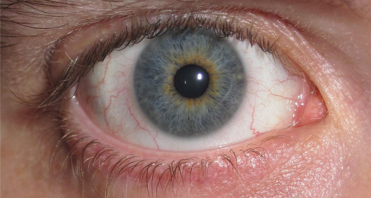 Iris Heterochromia: One Question That Sorts Benign From Concerning