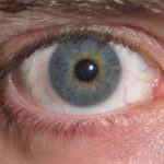 Iris heterochromia: a close-up of a human eye showing central heterochromia, with a golden-brown ring around the pupil contrasting with the blue-grey outer iris
