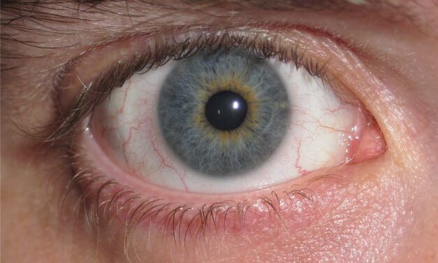 Iris Heterochromia: One Question That Sorts Benign From Concerning