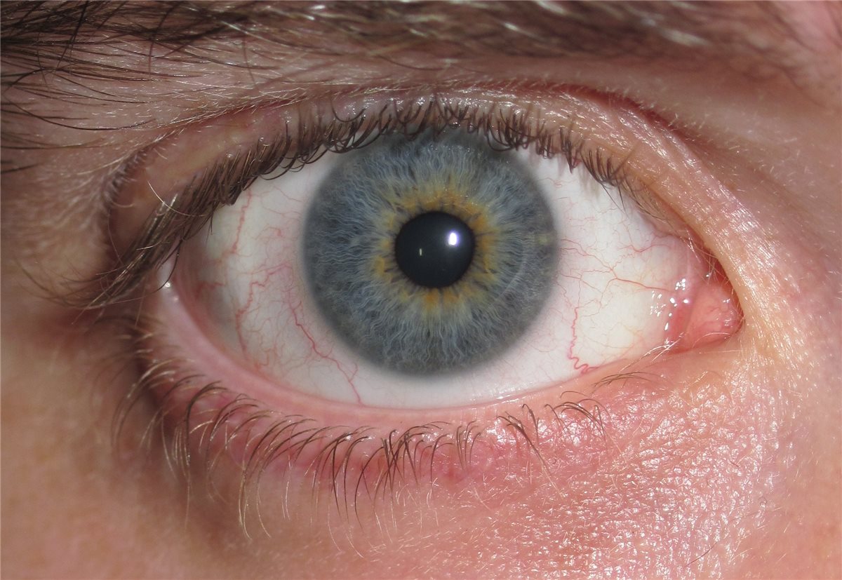 Iris heterochromia: a close-up of a human eye showing central heterochromia, with a golden-brown ring around the pupil contrasting with the blue-grey outer iris